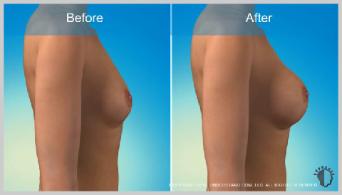 Breast_Augmentation_ RESULTADOS