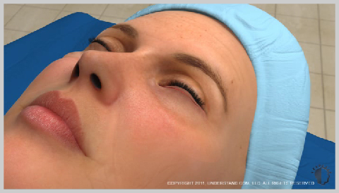 Eyelid-Surgery-Lower-OUTSIDE-LOWER-EYELID-PROCEDURE