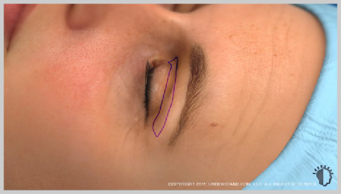 Eyelid-Surgery-Upper-PREPARATION