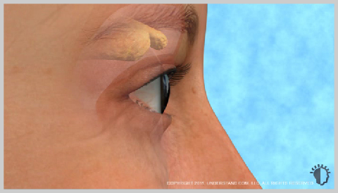 Eyelid-Surgery-Upper-WHAT-CAUSES-EYELIDS-TO-CHANGE