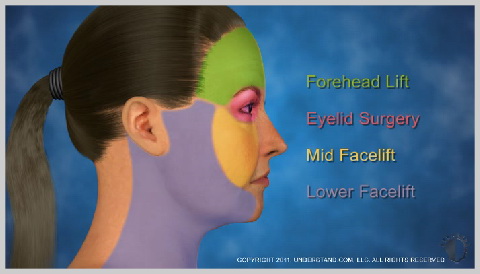 Facelift-Mid-HOW-A-MID-FACELIFT-WORKS