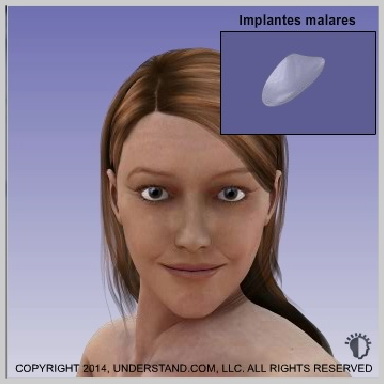 Implantes-de-mejillasmalares-IMPLANTES-DE-MEJILLAS-(MALARES)