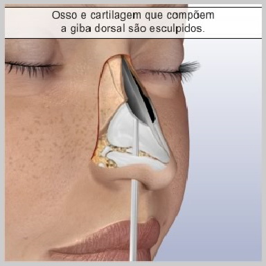 Rinopastia-Fechada-OSTEOTOMIA