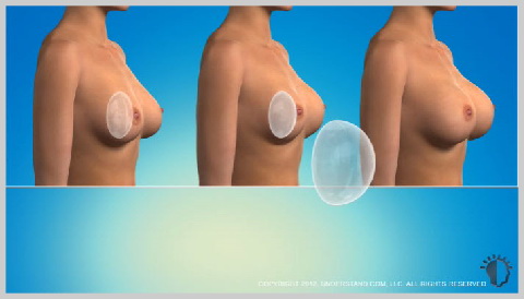 breast-augmentation-saline-implants-BREAST-AUGMENTATION-IMPLANT-OPTIONS