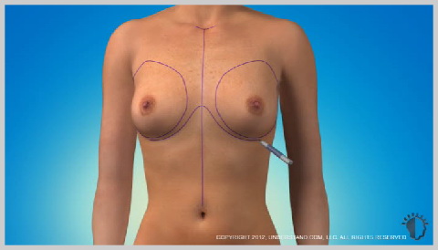 breast-augmentation-saline-implants-BREAST-IMPLANT-PREPARATION