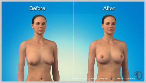 breast-lift-with-implants-RISKS-AND-RESULTS