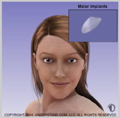 facial-implants-CHEEK-(MALAR)-IMPLANTS