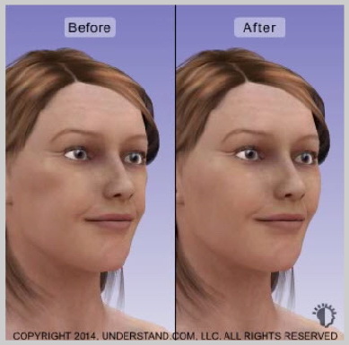 facial-implants-RESULTS