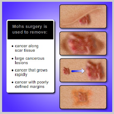 mohs-surgery-PROCEDURE