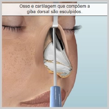 rinoplastia-aberta-REMOVENDO-A-GIBA-DORSAL